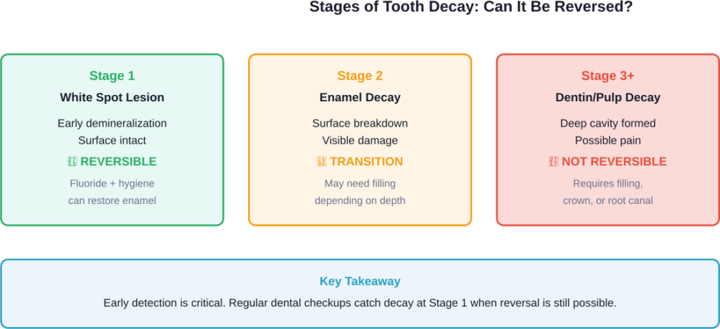 Tooth decay progression and treatment options at each stage, showing the narrow window for natural reversal.