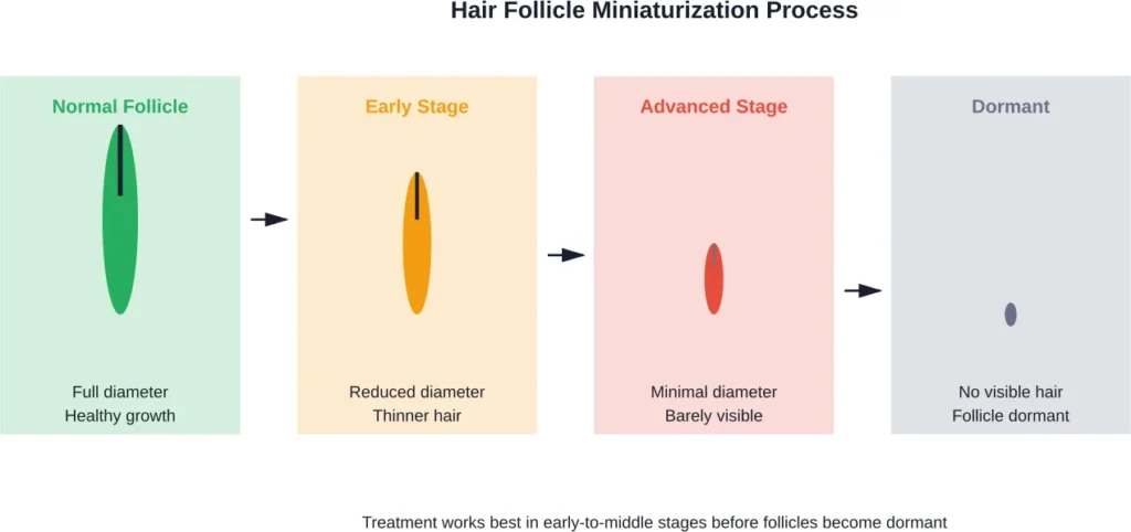 Progressive miniaturization of hair follicles showing why early intervention improves treatment success rates.
