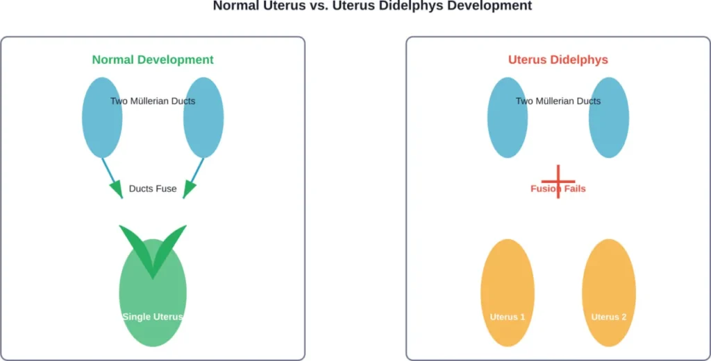 The developmental difference between normal uterine formation and uterus didelphys during fetal development