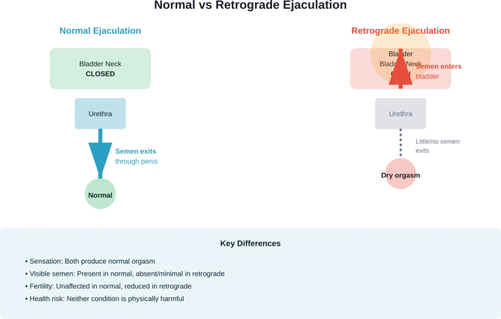 Comparison of normal ejaculation pathway versus retrograde ejaculation, showing how bladder neck muscle function determines semen direction