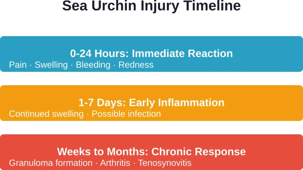 The progression of sea urchin spine injuries shows escalating complications when fragments remain embedded.